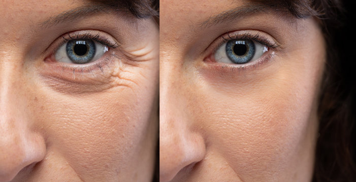 Anti-Aging & Wrinkle Treatments From a Dermatologist in Olympia Heights